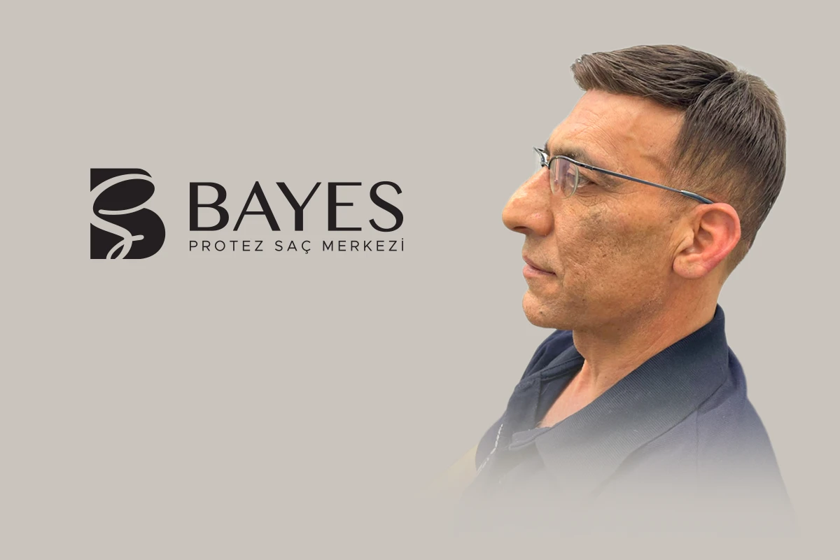Alın Bölgesi Protez Saç