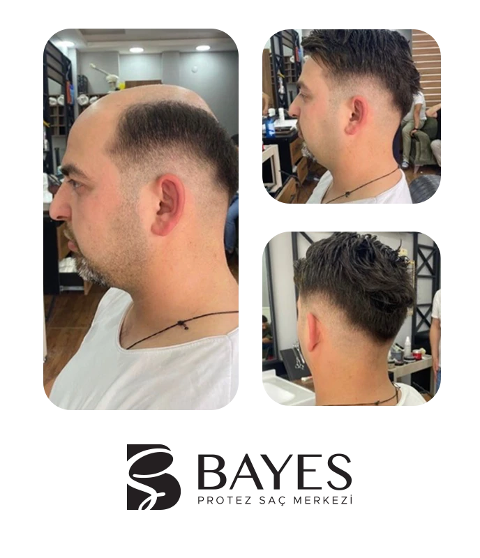 BAYES PROTEZ SAÇ MERKEZİ