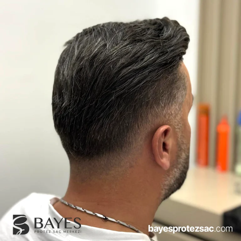 Alın Bölgesi Protez Saç