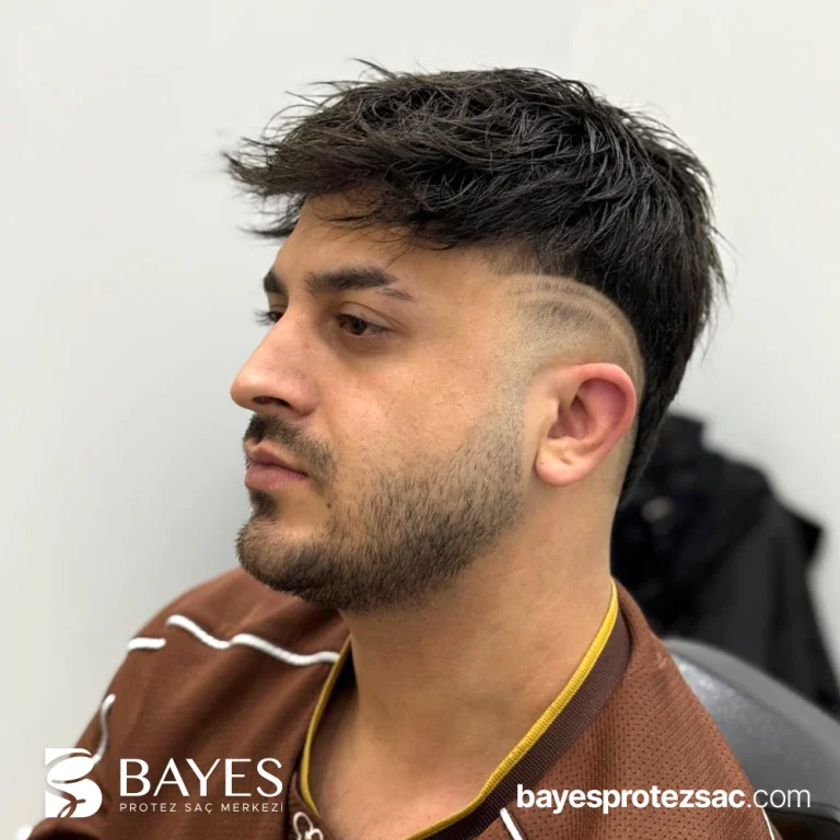 Alın Bölgesi Protez Saç