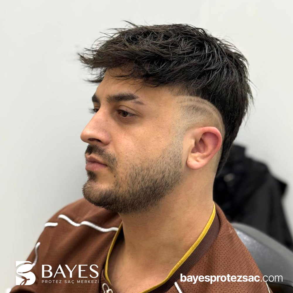 Alın Bölgesi Protez Saç