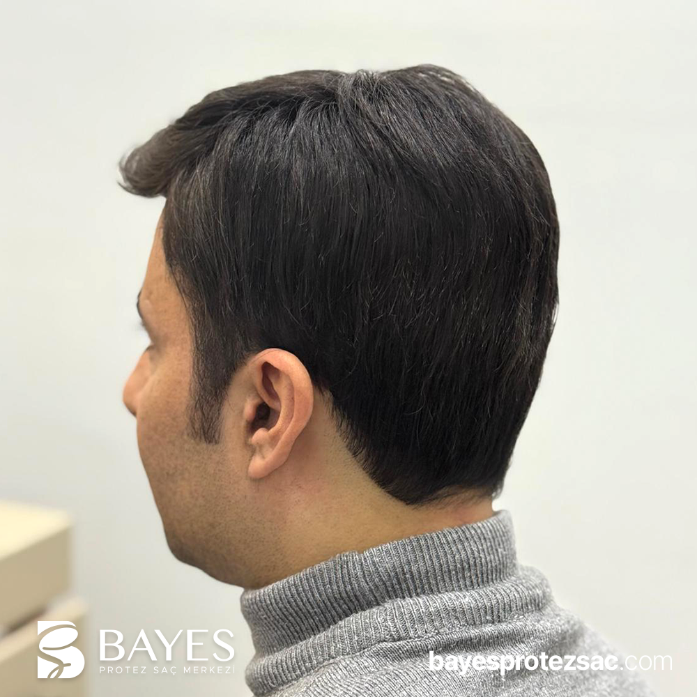 Bantsız Protez Saç