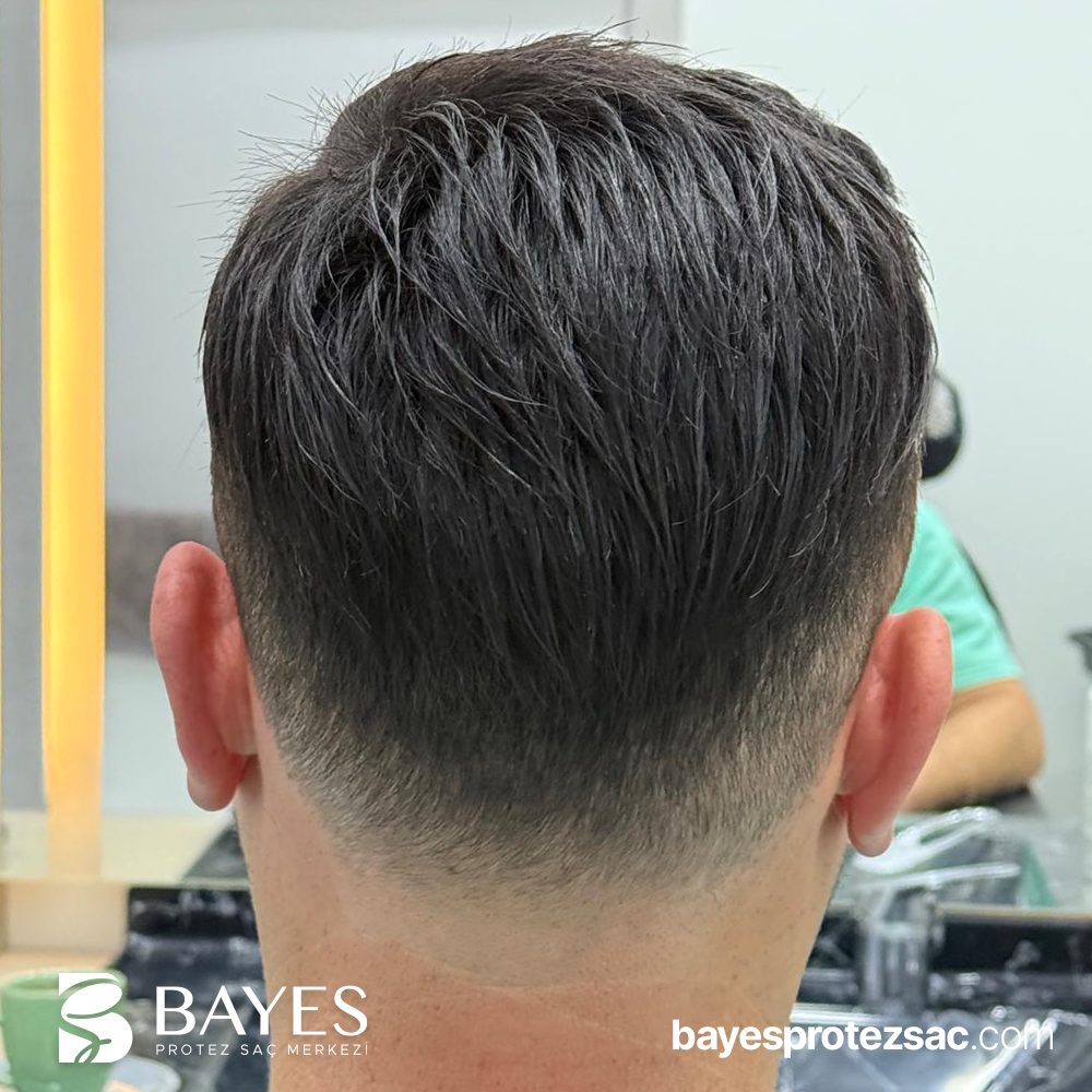 Bantsız Protez Saç