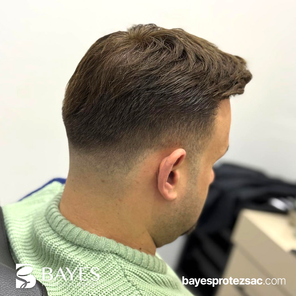 Erkek Protez Saç Nedir