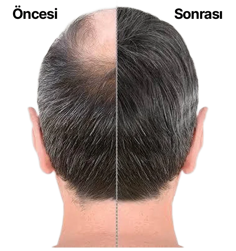 Pendik Protez Saç Merkezi - Bayes Protez Saç Merkezi