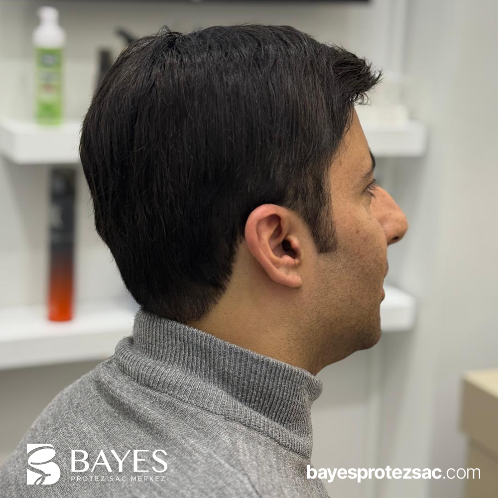 Protez Saç Çeşitleri