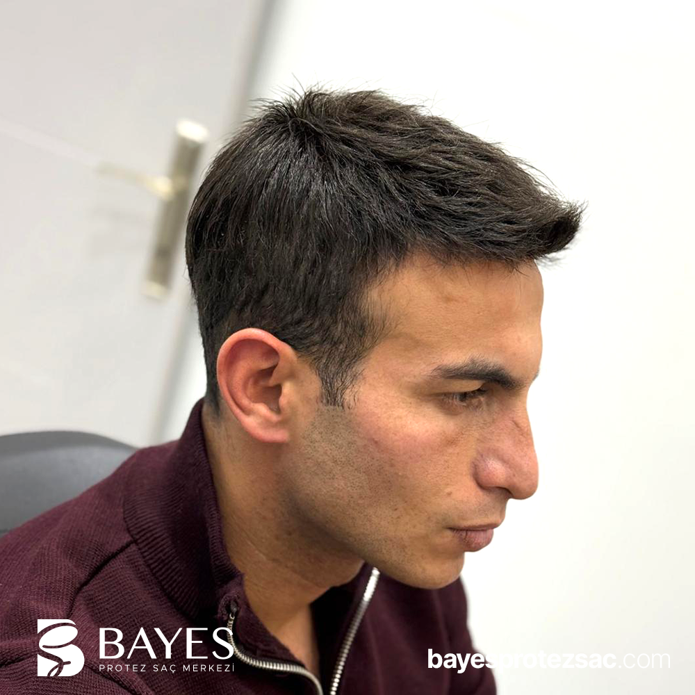 Protez Saç Uygulama Teknikleri